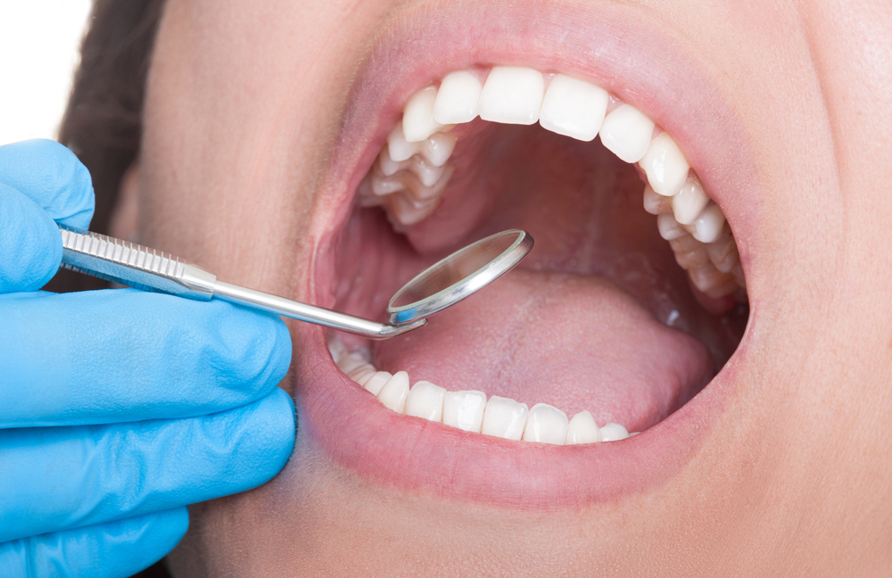 No solo son sinónimo de dolor dental, las muelas del juicio también son importantes 