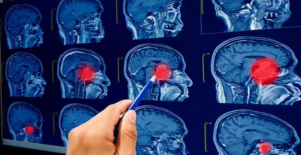 ¿Cómo cuidar la salud cerebral y evitar los temidos tumores?