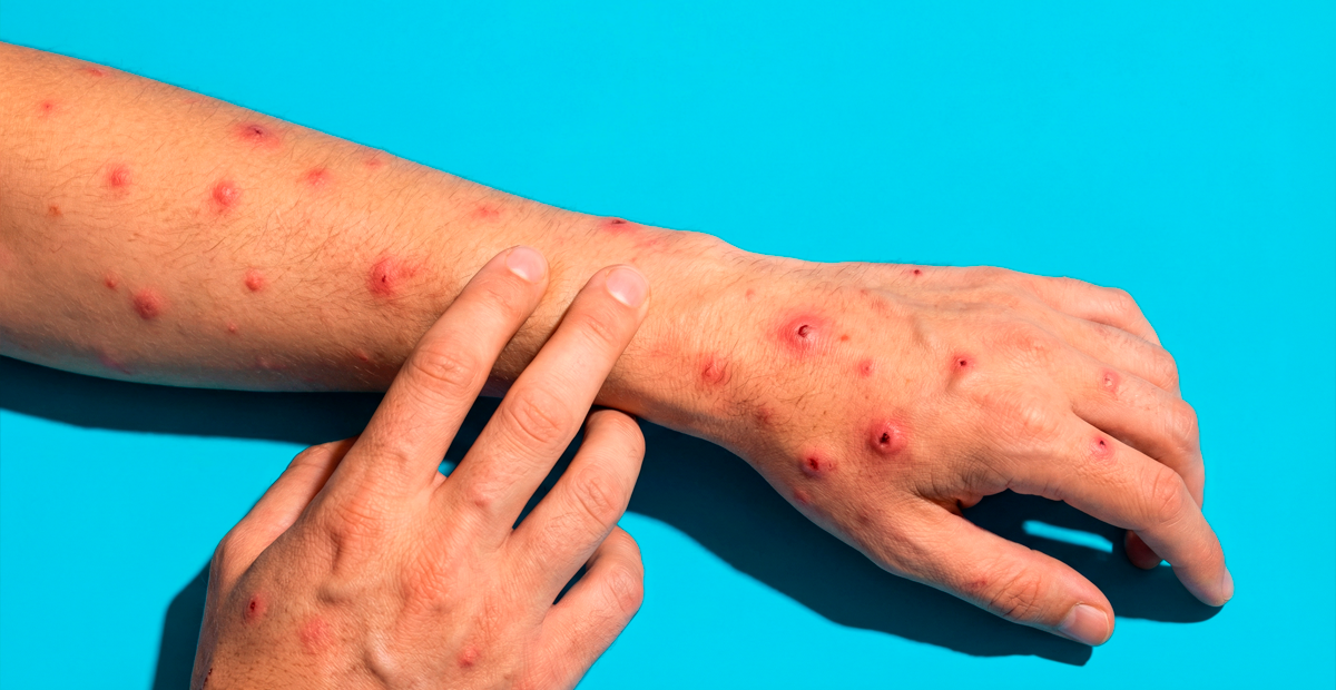 Viruela del mono: cómo prevenirla y cuál es la situación epidemiológica en Bolivia